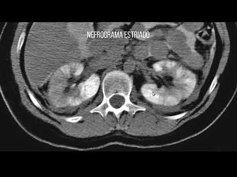Striated nephrogram in abdominal trauma (renal contusion)
