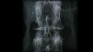 Hyper-C™ Anterior Cervical Plate System - DeGen Medical