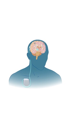 1.4K views | Deep brain stimulation (DBS) can reduce the severity and frequency of seizures due to epilepsy. Learn more about how DBS works and what to expect: https://duke.is/dbs Duke Neurosurgery | Duke Health | Facebook