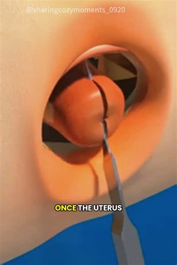 Hysterectomy Procedure 3D Animation #hysterectomy #hysterectomysurgery #hysteroscopy #hysteroscopysurgery #hysteroscope #hysterectomyjourney #medical3danimation #3dmedicalanimation
