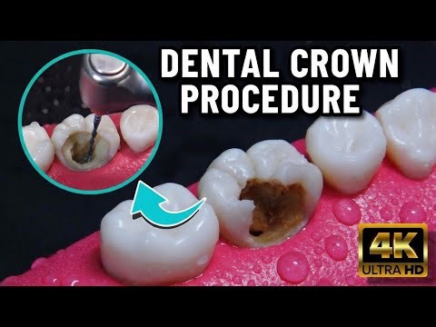 Tooth Damaged by Caries? How Dentists Save a Tooth with Root Canal Therapy . ASMR