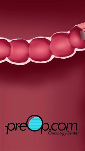 PreOp® Colonoscopy Explained | Prep, Procedure, and Recovery