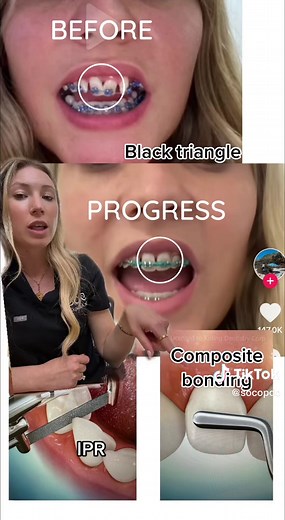 Black Triangles: Understanding & Fixing Gaps Between Teeth