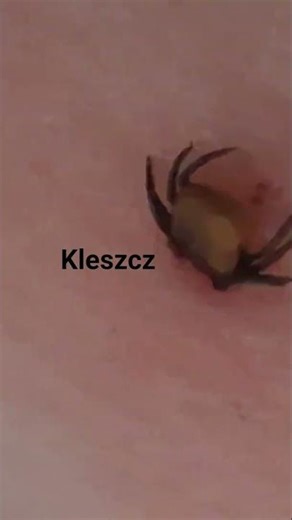 kleszcz w ciele