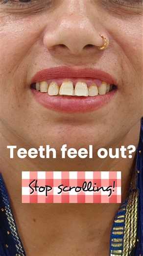 Teeth feel out? STOP scrolling! #braces #smilemakeover #smile