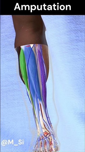 Cutting off a Leg (Amputation)