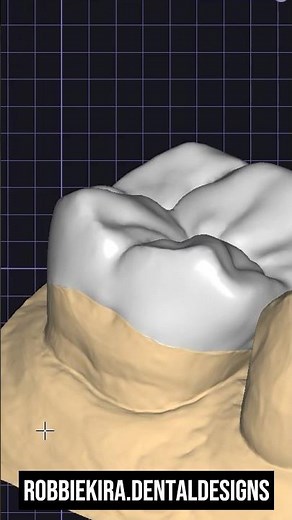 Optimizing Margin Thickness in Exocad. #exocadtips