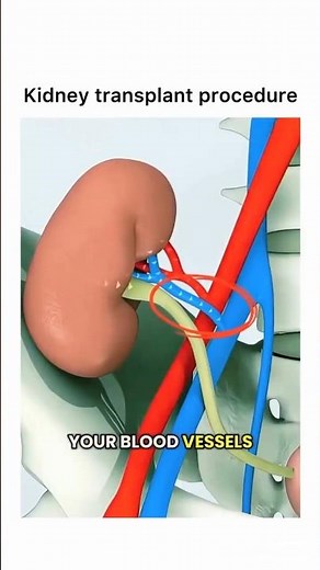 Kidney Transplant Process Explained | Step by Step Surgery Guide