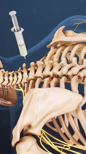 93K views · 434 reactions | Need to know what really happens during spinal cord stimulation? In this video, we break down the spinal cord stimulator procedure, how it works to relieve chronic back and nerve pain, and what to expect before, during, and after surgery. Whether you're researching pain management options, curious about SCS trials, or wondering if a spinal cord stimulator is right for you, this step-by-step guide is packed with answers. | Spine-health | Facebook