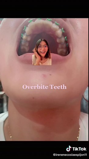 Overbite Teeth Braces Journey: Extraction for Braces Process