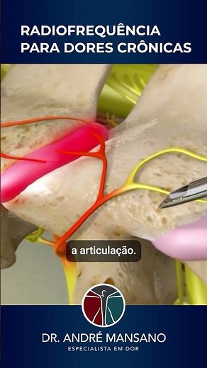How is radiofrequency ablation performed for chronic pain? Find out!