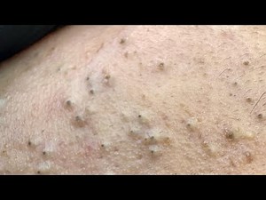 Deep Cleansing Facial Routine | Pimple Treatment & Blackheads Removal