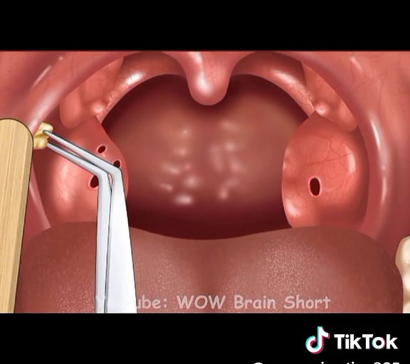 Asmr tonsils removal #asmr #satisfying #relax #animation #treatment | asmr