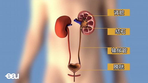 输尿管结石取石过程，3D演示。。#科普新知自习室