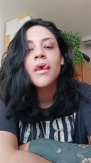 Understanding Tongue Splits: Pros and Cons