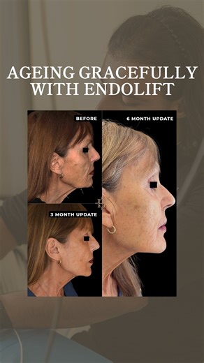 HPD Medical & Aesthetics Clinic | This patient in her mid-70’s presented with jowls, loose lower face skin and crepey texture. Challenges that require a careful, customised... | Instagram