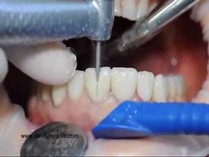 Procera Veneers Removal • Video • MEDtube.net