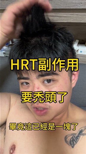 mauro on Instagram: "HRT三個月後，開始出現……………..禿…頭😎 #transgender #ftm #transguy #transboy #topsurgery#transformation#trans#hrt #testosterone #平胸#平胸手術 #我的故事 #跨性別#hrt"