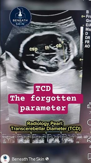Why Every Sonographer Should Measure TCD