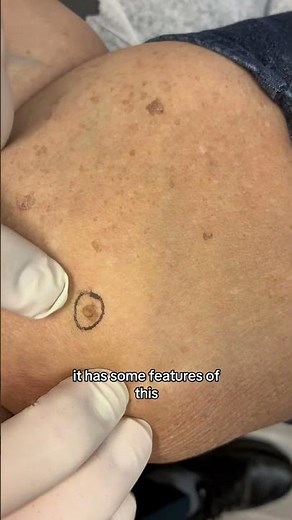 Dermatologist with 50 Years Experience Shows Different Mole Types on Patient #moles #moletypes