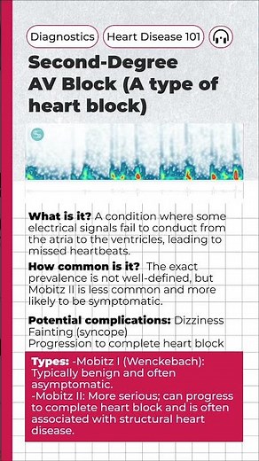 Heart Rhythm Abnormaity 101: Second-Degree AV Block (Mobitz II)