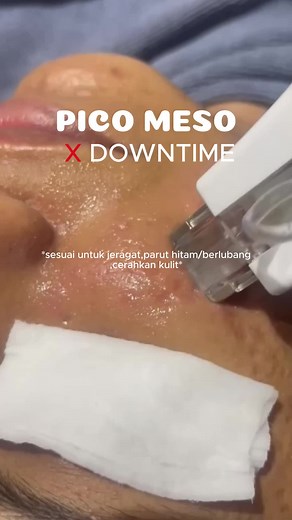 POV: Awak tengok cermin lepas 3 hari buat Pico Meso... kulit glowing macam pakai filter