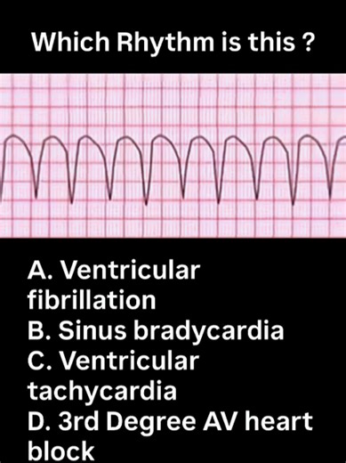 Can you spot the rhythm? 🫀⚡ ​Test your EKG interpretation skills with this quick quiz. This specific pattern is a critical find in emergency medicine and requires immediate recognition. ​Which rhythm is shown in the video? ​A. Ventricular fibrillation ​B. Sinus bradycardia ​C. Ventricular tachycardia ​D. 3rd Degree AV heart block ​Drop your answer in the comments below! 👇 ​#EKG #NurseLife #MedicalQuiz #Cardiology #FOAMed #MedStudent