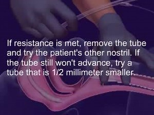 #Nasootracheal #Intubation | Anesthesia