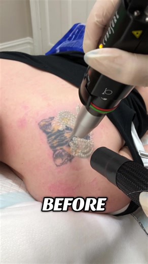 The sooner you start, the sooner it’s gone! 📍: CBD 0466882965 📍: WINDSOR 0466425316 💌: swifttattooremoval.com.au #tattooremovalmelbourne #melbournetattooremoval #tattooremoval #melbourne #beforeandafter