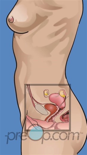 PreOp® Vaginal Hysterectomy: Questions To Ask Your Surgeon + Warning Signs #shorts