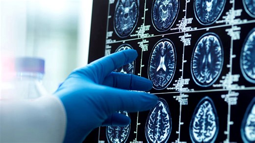 Men's brains shrink faster than women's, as researchers explore Alzheimer's connection