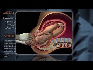 shoulder dystocia l عسر ولادة الكتف