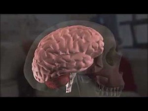 Hemorrhage and Ischemic Stroke Animation