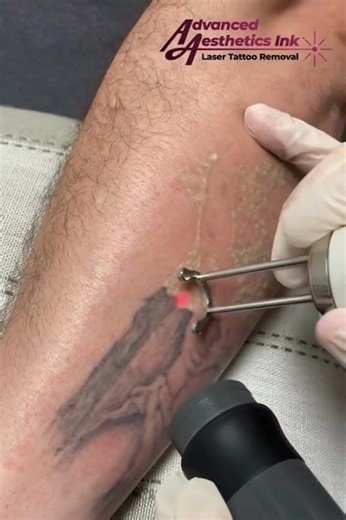 Wondering how many sessions it takes to remove a tattoo?