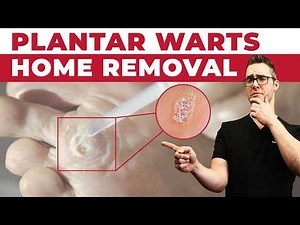 Plantar Warts On Feet And Toes [BEST HOME TREATMENTS]