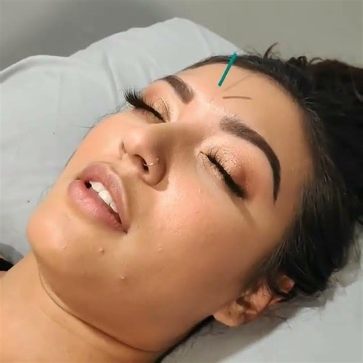 "I Tried Cosmetic Acupuncture for 30 Days (Real Results)"