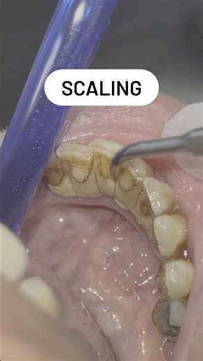 The Most Satisfying Tartar Removal You’ll See Today! 🦷✨ ASMR