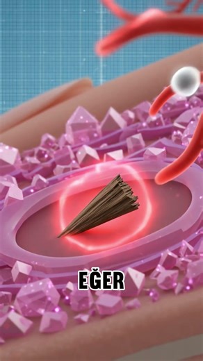 How to remove splinters 😲