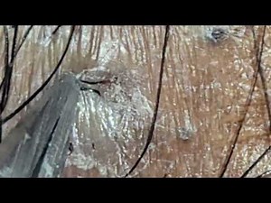 Ingrown hair extraction 16 of 2023