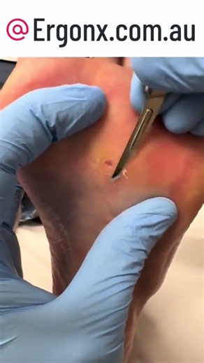 Satisfying Corn Removal from Foot Amazing Transformation #Podiatry #FootCare