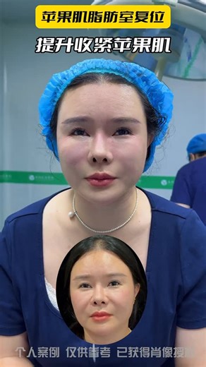 DR-wu on Instagram: "9D可视提升紧致让面部不在老下去#面部提升#少女脸#整形"