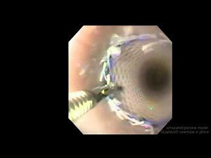 RAPTOR™ Grasping Device: SEP Esophageal Stent Removal