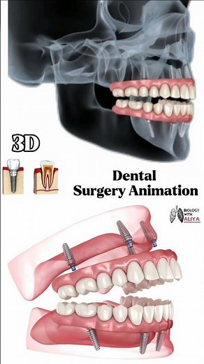 Dental Surgery Animation #dental #shorts