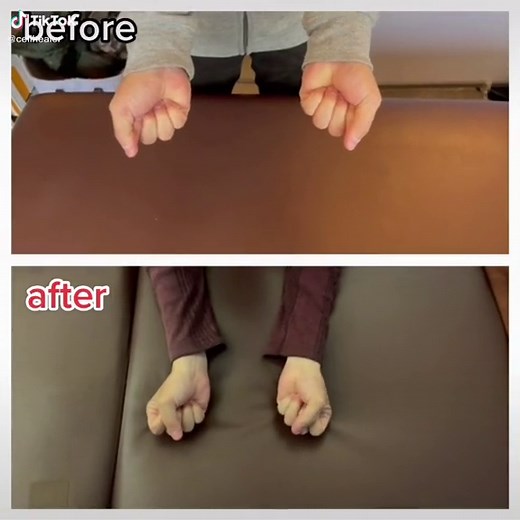 Muscular dystrophy ( myotonic dystrophy) client after 10 times treatment. Myotonia symptom is improved. #myotonicdystrophy #musculardystrophy