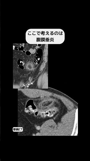 腹膜垂炎 #radiology #画像診断#shorts