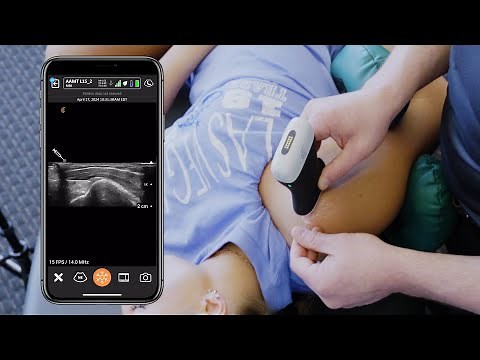 USG Dry Needling of the Supraspinatus