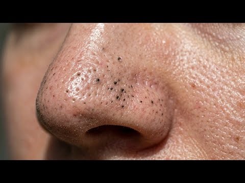 Acne Treatment Deep Pore Cleansing & Blackhead Extraction