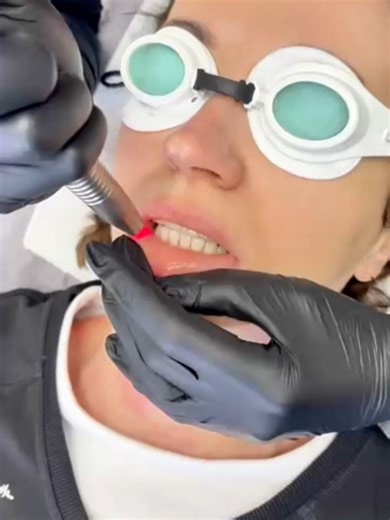 Fuller, smoother, naturally enhanced lips — no needles required! Fotona LipLase uses gentle laser energy to stimulate collagen inside and outside the lips for subtle volume and restored definition. 📲 Cape Town: 076-402-9762 #NuSkinnovation #Fotona #FotonaFamily #Fotonalasers #ChooseFotona #LipLase #NaturalLips #LipEnhancement #SoftVolume #GlowUp #BeautyTrendsSA