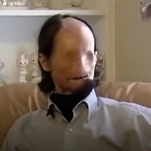 Dallas Wiens had a terrible accident. That drastically changed his life. He was called the “faceless mn”. Because hi face turned into a meat mask. But Dallas would get a second chance. When a group of doctors took the challenge to help him. | The Witness