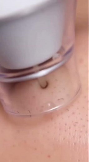 The Most Satisfying Pores You'll Ever See Unclog! (Pure Satisfaction)